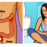 Unusual signs of colon cancer that women often ignore