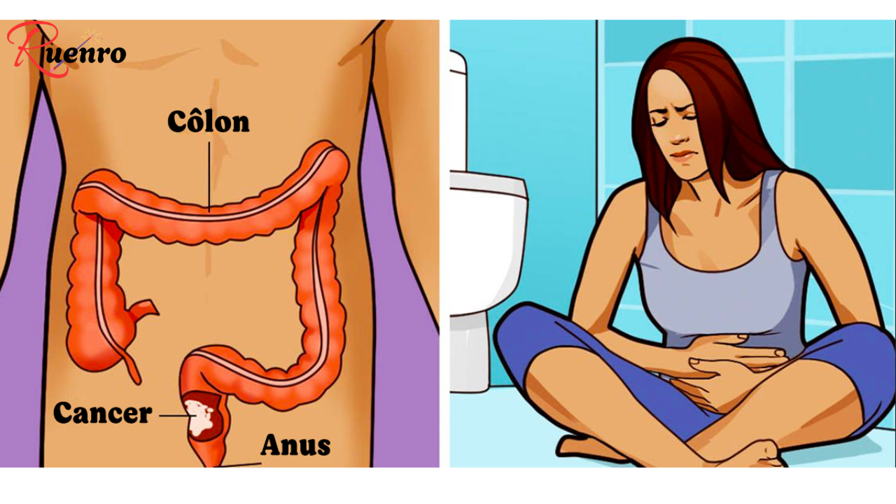 Unusual signs of colon cancer that women often ignore