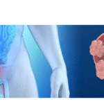 5 Warning Signs of Bladder Cancer You Should Never Ignore