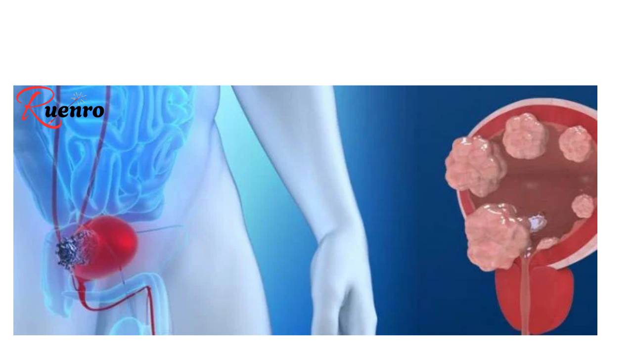 5 Warning Signs of Bladder Cancer You Should Never Ignore