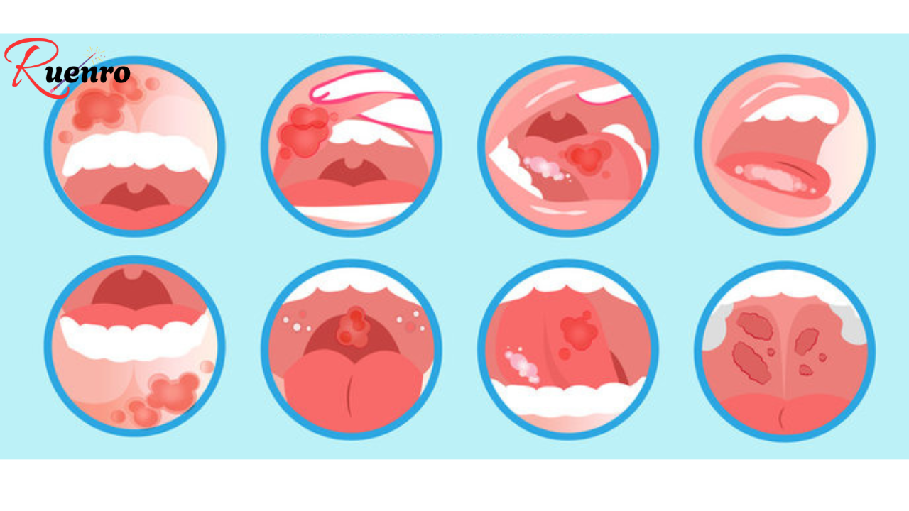 Warning Signs of Oral Cancer: Are You at Risk?