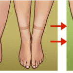 6 Causes of Water Retention and How to Reverse It