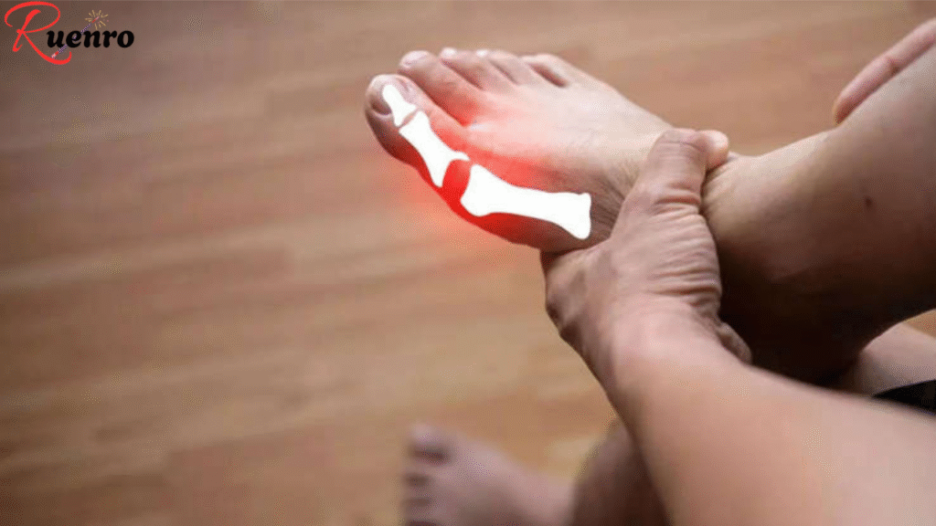 How to Stop a Gout Attack