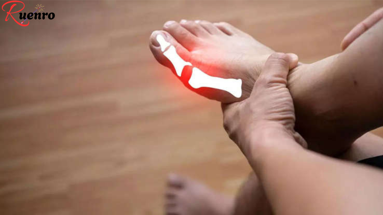 How to Stop a Gout Attack